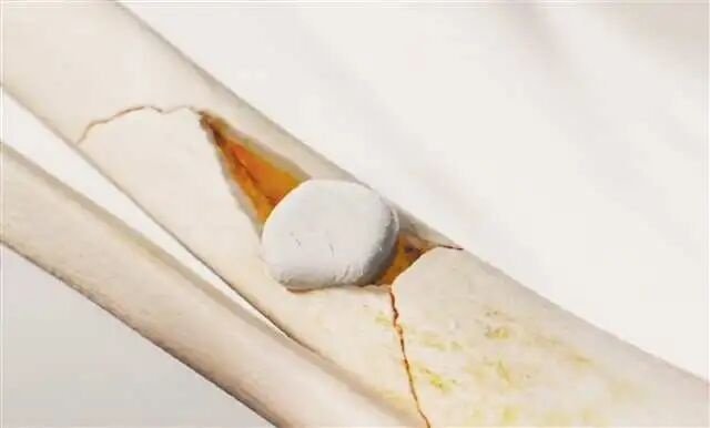 20260420 chongqing nuwa stone bone repair material revolution 5