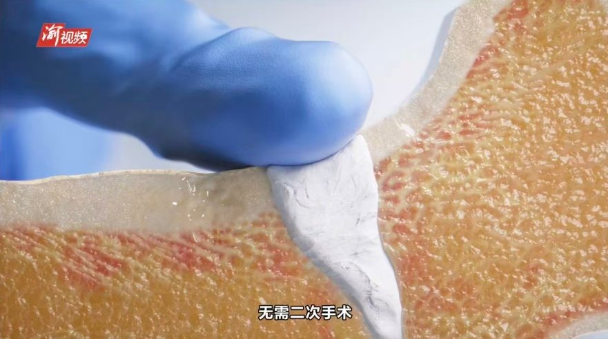 20260420 chongqing nuwa stone bone repair material revolution 6